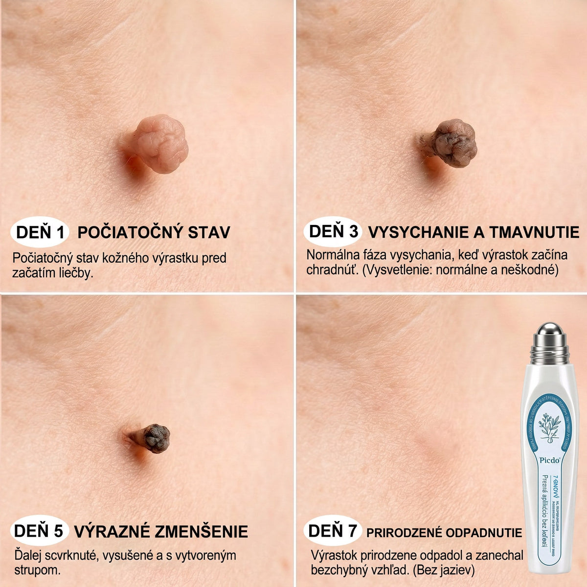 𝐏𝒊𝐜𝐝𝒐® 👩‍⚕️🌍7-𝑫ň𝒐𝒗ý 𝑵𝒂 𝑶𝒅𝒔𝒕𝒓𝒂ň𝒐𝒗𝒂𝒏𝒊𝒆 𝑷𝒊𝒈𝒎𝒆𝒏𝒕𝒐𝒗ý𝒄𝒉 Š𝒌𝒗ŕ𝒏 𝑨 𝑱𝒂𝒛𝒊𝒆𝒗 𝑷𝒆𝒓𝒐(𝐵𝑒𝑧 𝑏𝑜𝑙𝑒𝑠𝑡𝑖, 𝑏𝑒𝑧 𝑗𝑎𝑧𝑖𝑒𝑣 – 𝑟𝑜𝑙𝑙𝑒𝑟𝑏𝑎𝑙𝑙)
